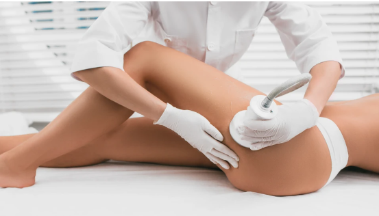 Formation Lipocavitation - Radiofréquence & Lipolaser